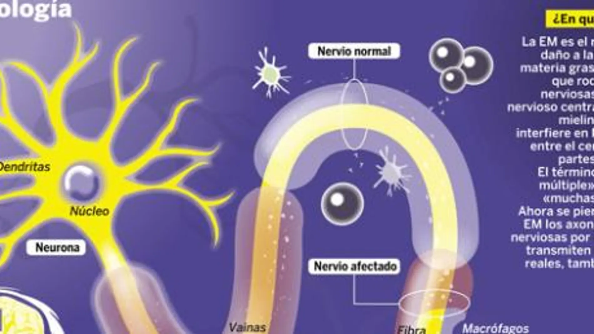 Esclerosis múltiple: los primeros tratamientos en forma de pastillas invitan al optimismo