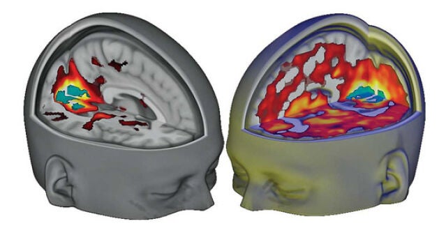 Resonancia magnética funcional de los cerebros de una persona bajo los efectos del LSD