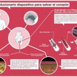 Tratan al primer paciente coronario en España con un innovador Dispositivo Vascular Biorreabsorbible