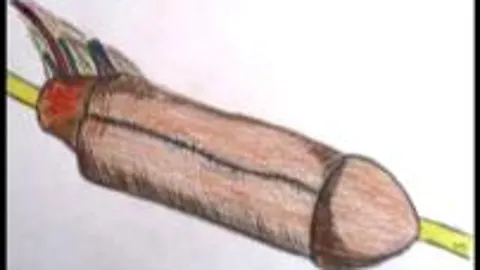 Ilustración facilitada por la CAM que muestra la intervención realizada, por primera vez en España, por especialistas del Servicio de Urología y de Cirugía Plástica del Hospital Universitario 12 de Octubre que han realizado una reconstrucción completa de