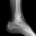 Un tercio de las mujeres españolas de más de 50 años sufre osteoporosis