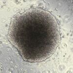Identificados tres genes que permiten al cáncer de mama invadir el cerebro