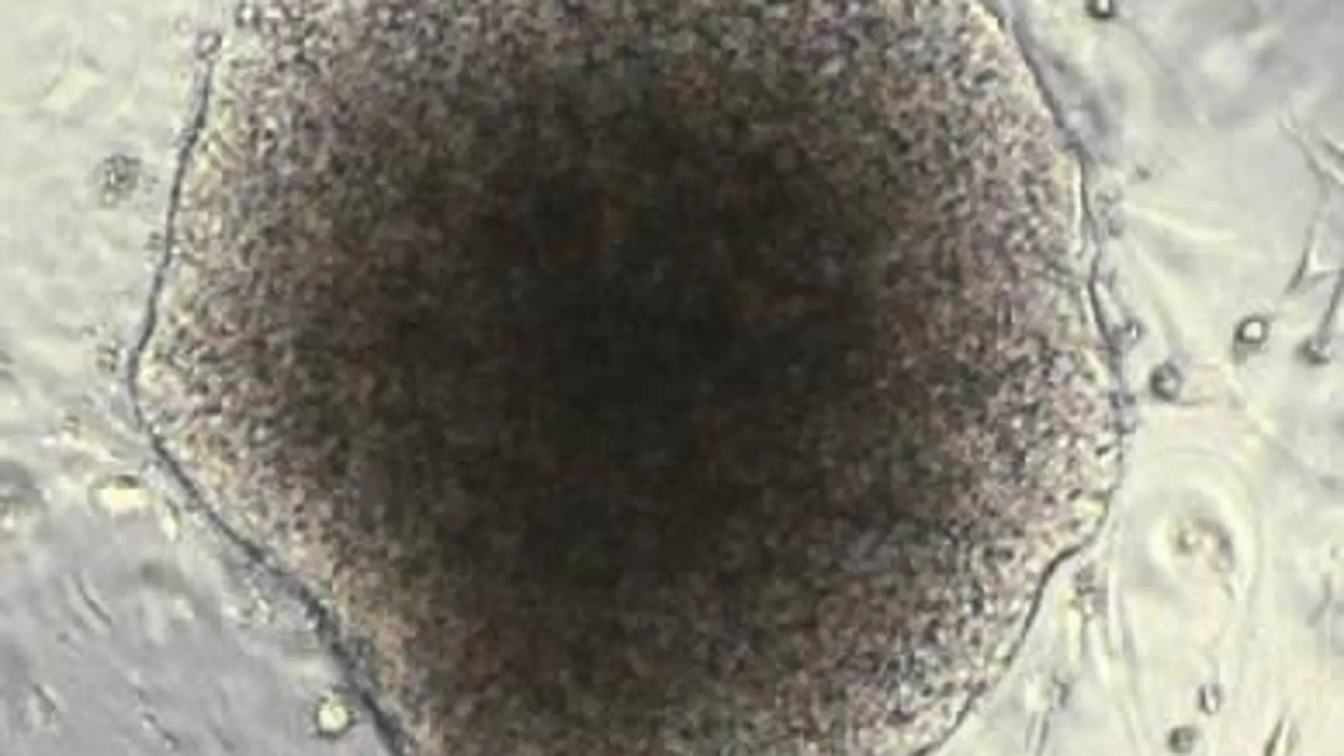 Identificados tres genes que permiten al cáncer de mama invadir el cerebro
