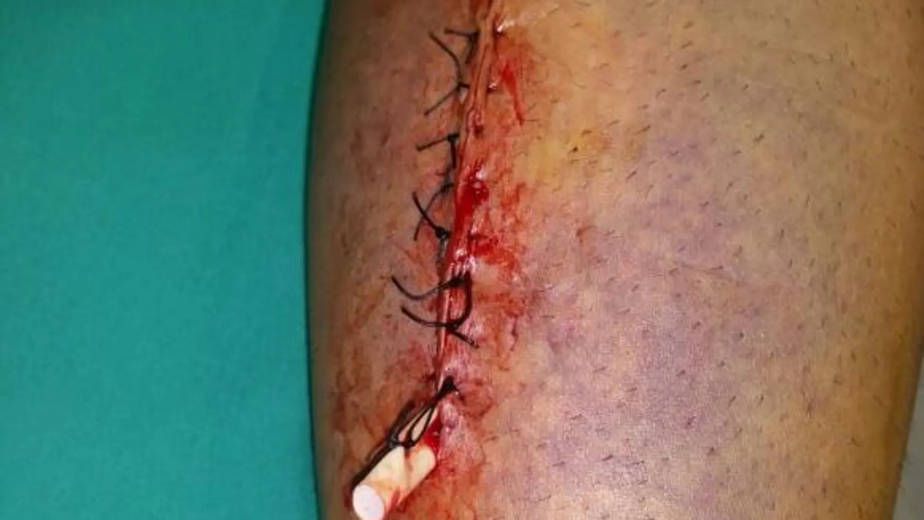 Imagen de la herida del diestro en el gemelo, tras la intervención