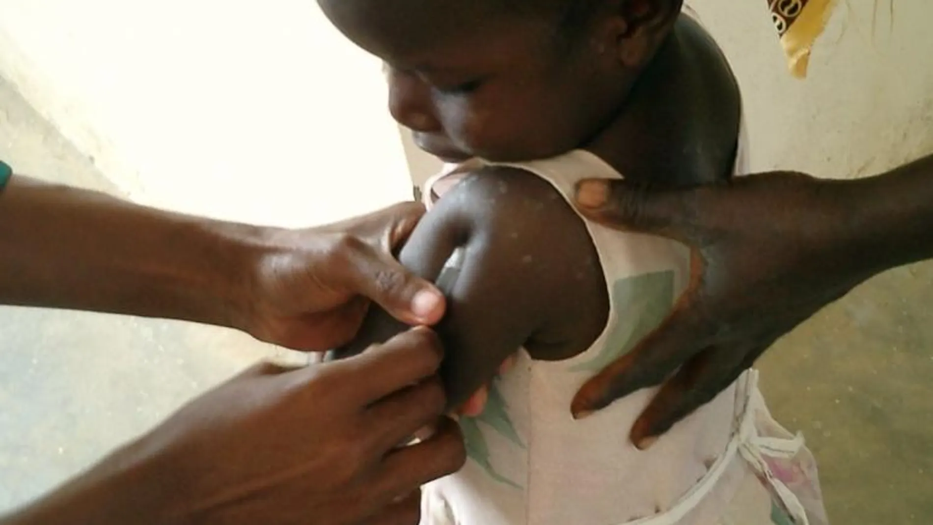 Una niña se vacuna contra la malaria