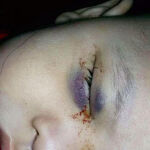 El menor fue intervenido de un tumor maligno en el ojo derecho y le extirparon el derecho