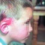 Un niño que fue atacado por pastores alemanes