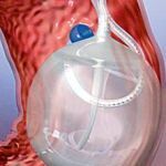 Balón ajustable contra la obesidad