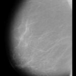 Detalle de una de las mamografías utilizadas durante la investigación.