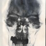 Radiografía que se conserva de la cabeza del führer perteneciente a su historial médico
