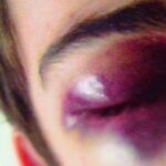 Fotografía de un joven agredido durante un enfrentamiento entre amigos de Palomino y grupos neonazis