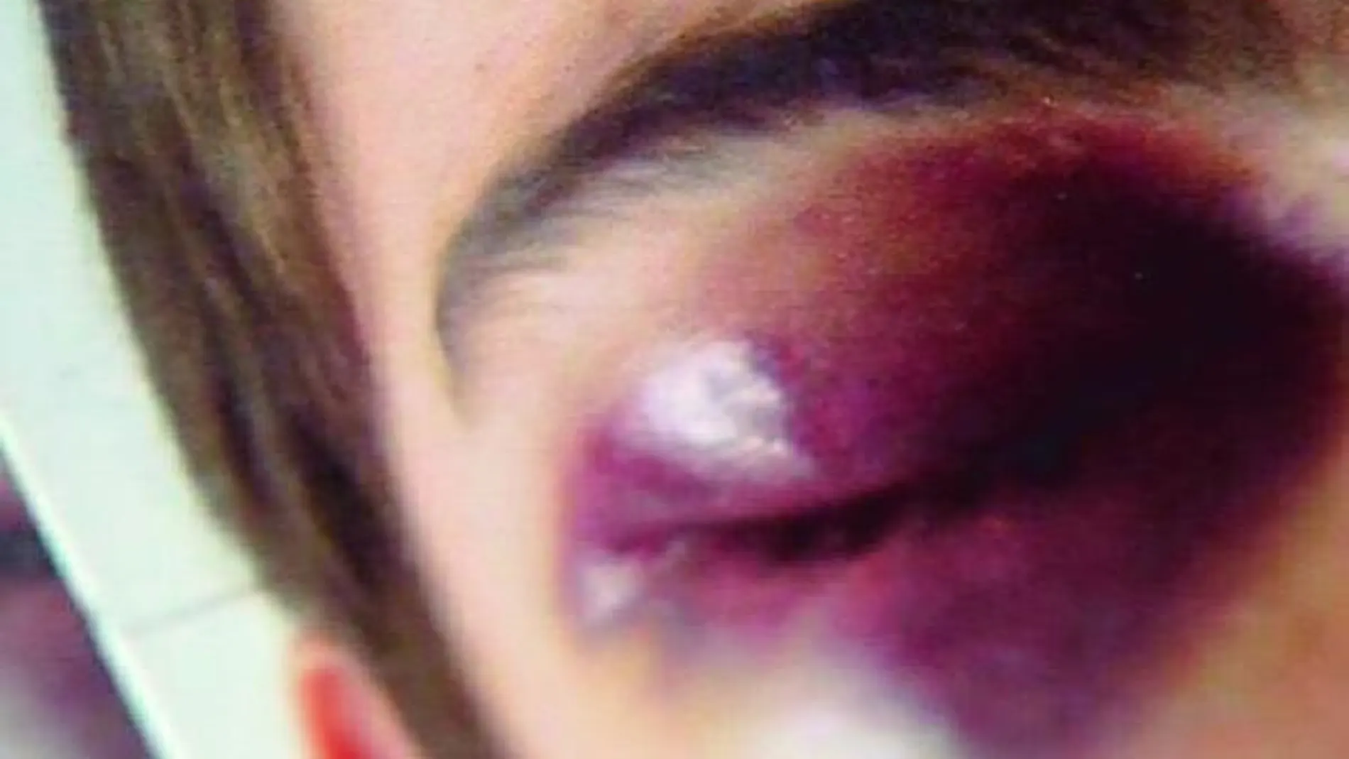 Fotografía de un joven agredido durante un enfrentamiento entre amigos de Palomino y grupos neonazis