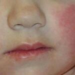 La enfermedad del “niño abofeteado”. ¿Sabes lo que es? ¿Y cuales son sus síntomas y tratamiento?