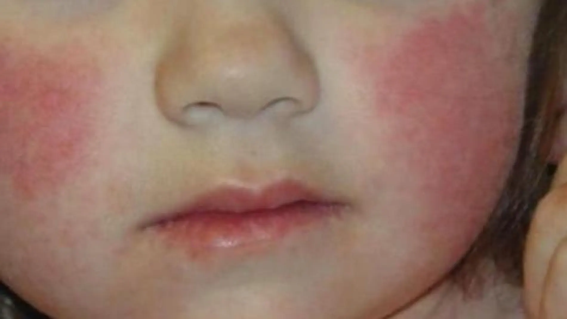 La enfermedad del “niño abofeteado”. ¿Sabes lo que es? ¿Y cuales son sus síntomas y tratamiento?