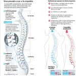 Un fármaco mejora los signos del doloroso «puente» en la espalda