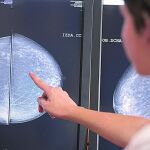 Medicina «a medida» contra el cáncer de mama