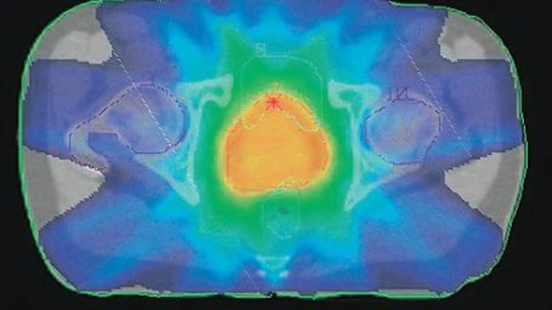 Radioterapia de intensidad modulada avance contra el cáncer por el Dr Rodrígo GARCÍA-ALEJO