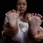 Nace un niño con 31 dedos pero sin pulgares en China