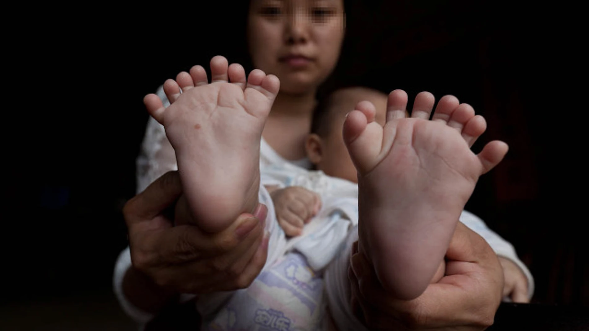 Nace un niño con 31 dedos pero sin pulgares en China