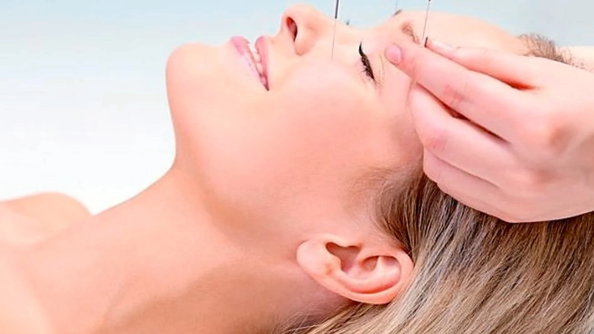 Lifting facial con acupuntura