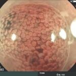 Endoscopias en alta definición para un diagnóstico temprano