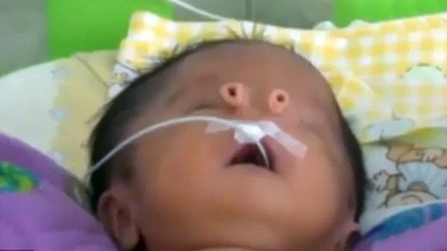 Un bebé nace con dos narices en forma de tubo