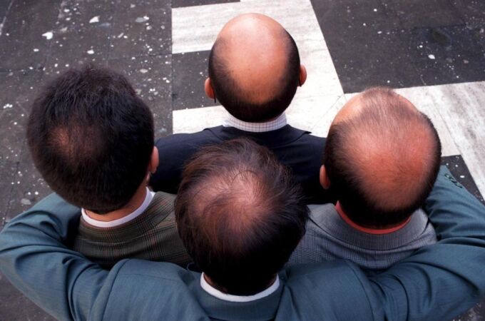 La alopecia está entre las enfermedades autoinmunes humanas más comunes