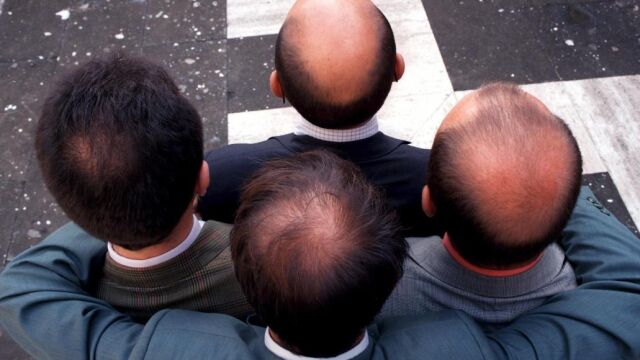 La alopecia está entre las enfermedades autoinmunes humanas más comunes