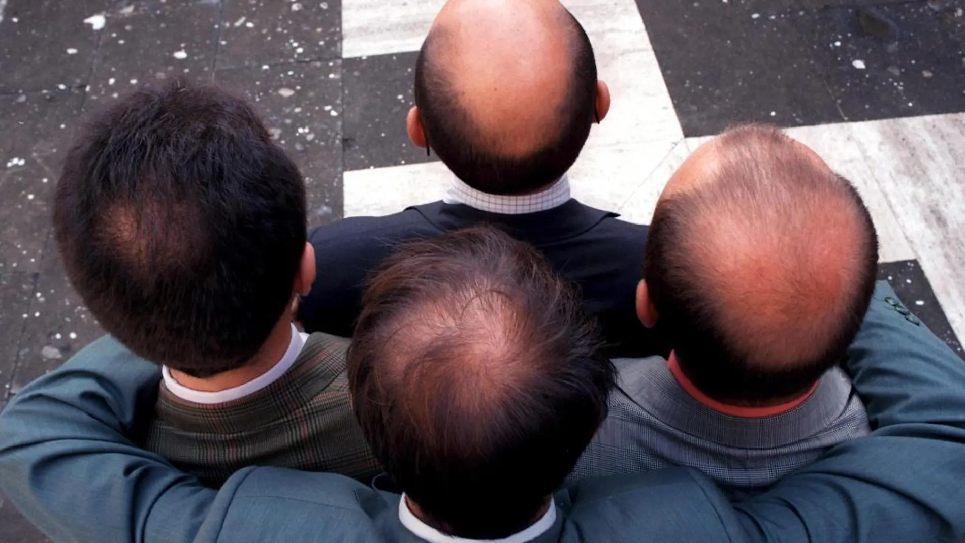 La alopecia está entre las enfermedades autoinmunes humanas más comunes