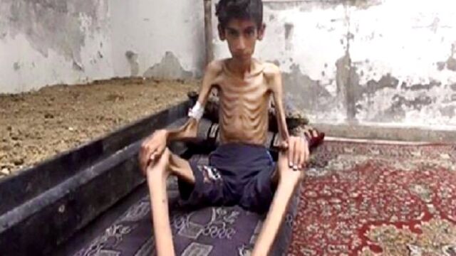 Un niño hambriento en Madaya