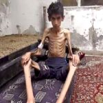 Un niño hambriento en Madaya