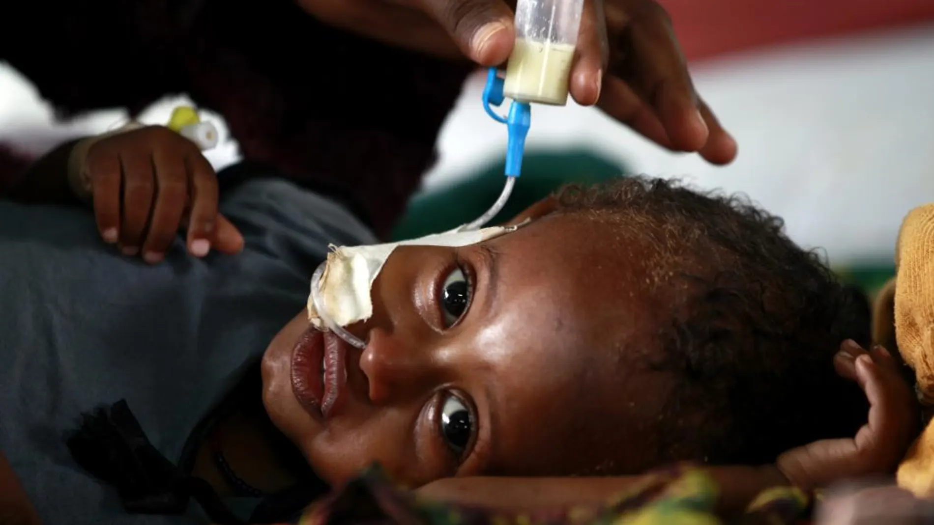 Un niño afectado por desnutrición es atendido en la frontera de Somalia