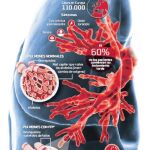 Sólo el diagnóstico precoz frena la fibrosis pulmonar idiopática