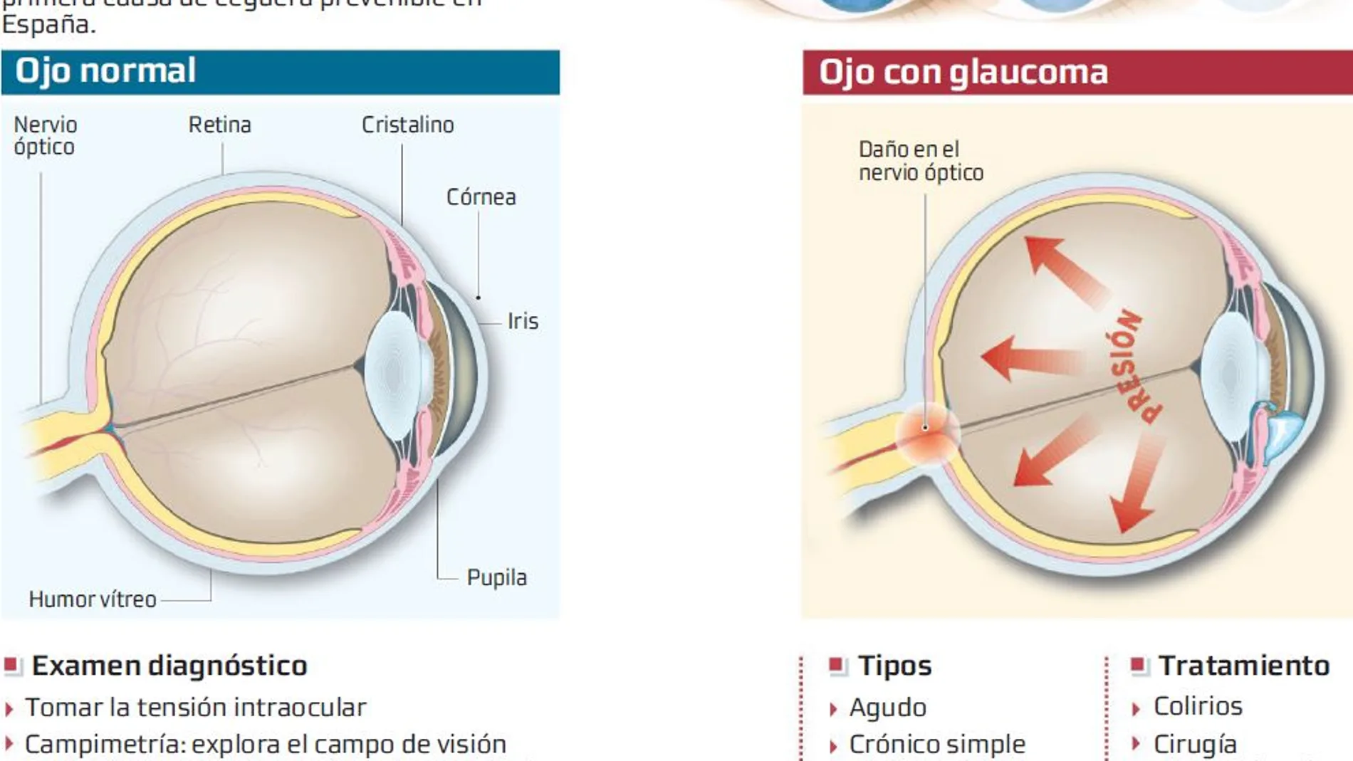 La mitad de las personas con glaucoma no lo sabe