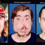 El antes y el después de Cameron Underwood, trasplantado de cara.