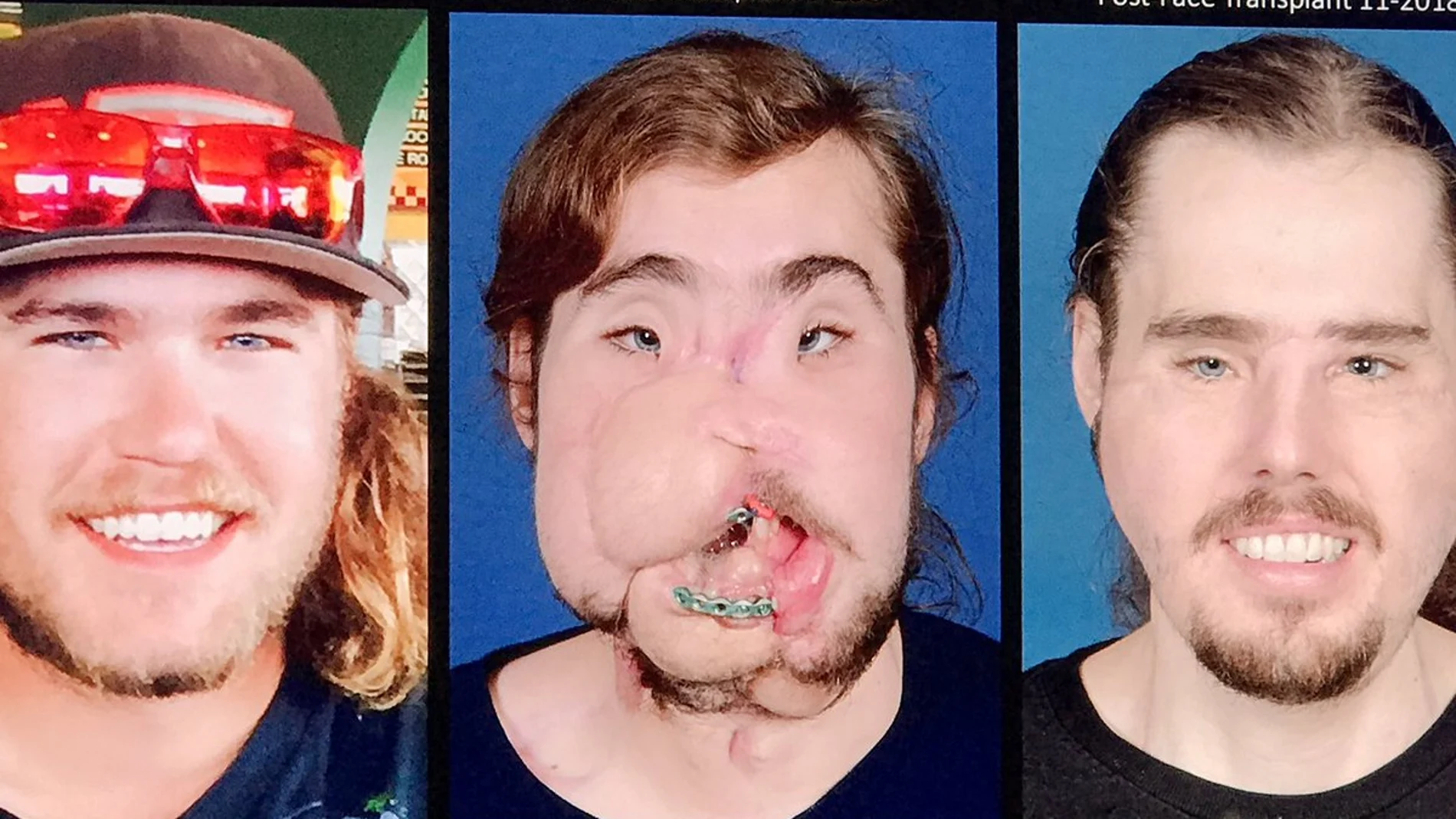 El antes y el después de Cameron Underwood, trasplantado de cara.