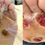 Las heridas causadas en los pies del hombre