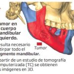 Reconstrucción de mandíbulas a golpe de impresión 3D