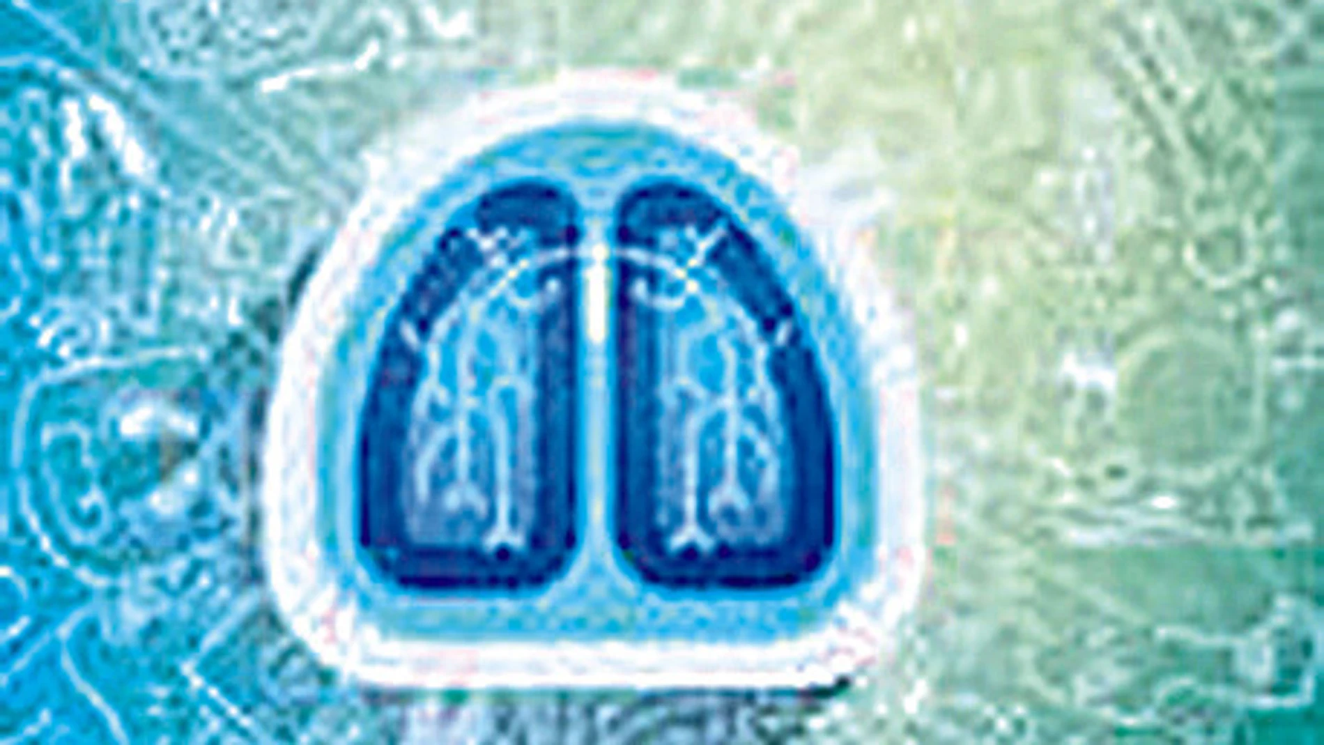 Datos positivos para una terapia contra el cáncer de pulmón microcítico