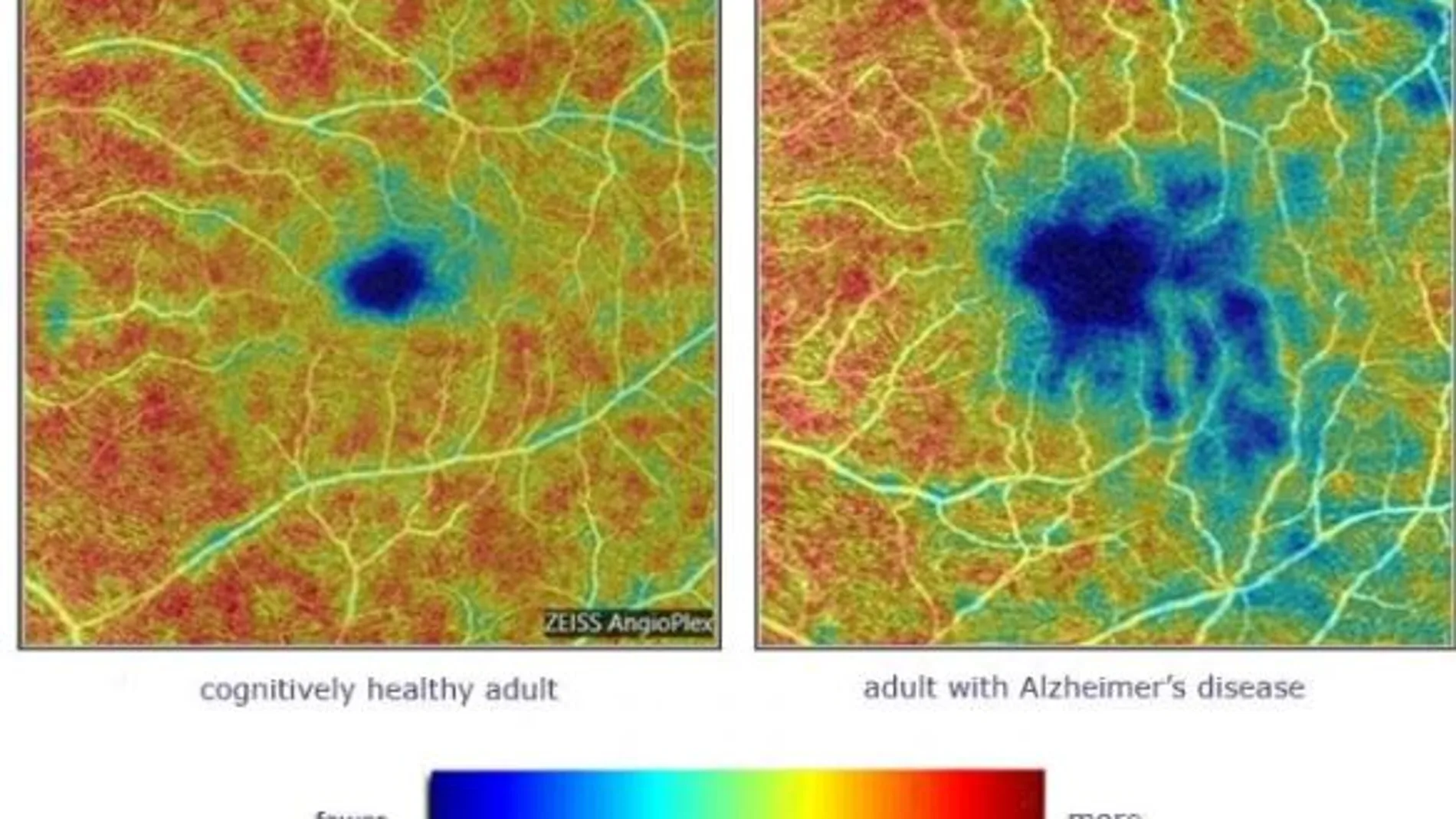 A la derecha, la retina de una persona con la enfermedad de Alzhéimer. Las áreas en azul y verde muestran donde los vasos sanguíneos son menos densos