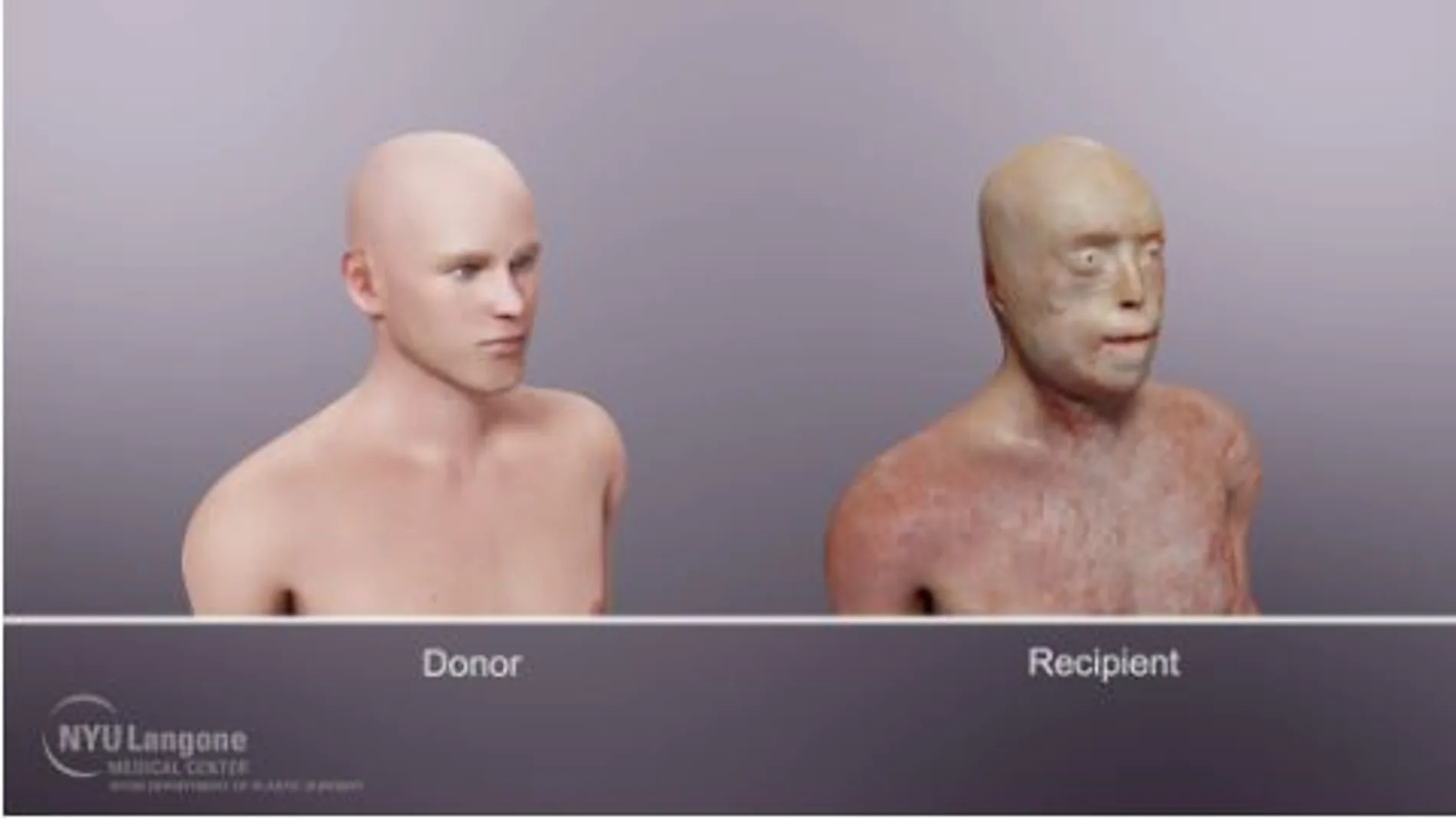 El espectacular resultado del mayor trasplante de rostro de la historia