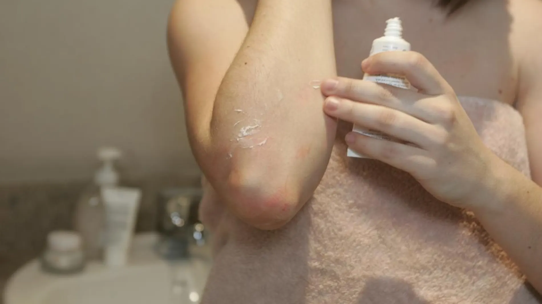 «Borrar» la psoriasis en casos moderados gracias a un nuevo biológico de primera línea