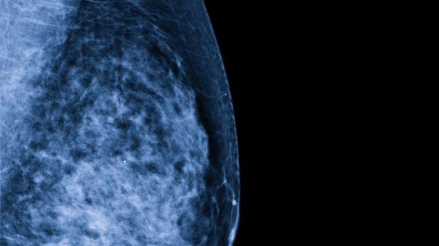 Una mamografía