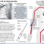 Menos riesgo de hemorragia con cateterismos a través del brazo