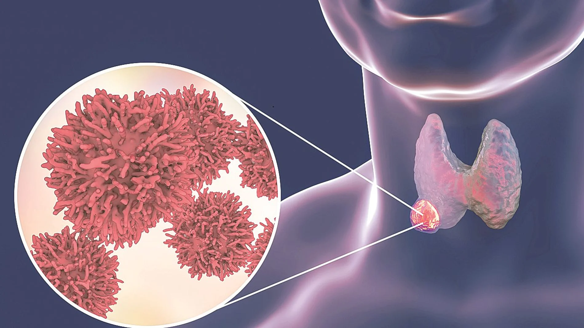 Cáncer de tiroides: factores de riesgo, prevención, síntomas y tratamiento