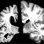 En la imagen de la izquierda, un cerebro con alzheimer. A la derecha,el cerebro sin la enfermedad