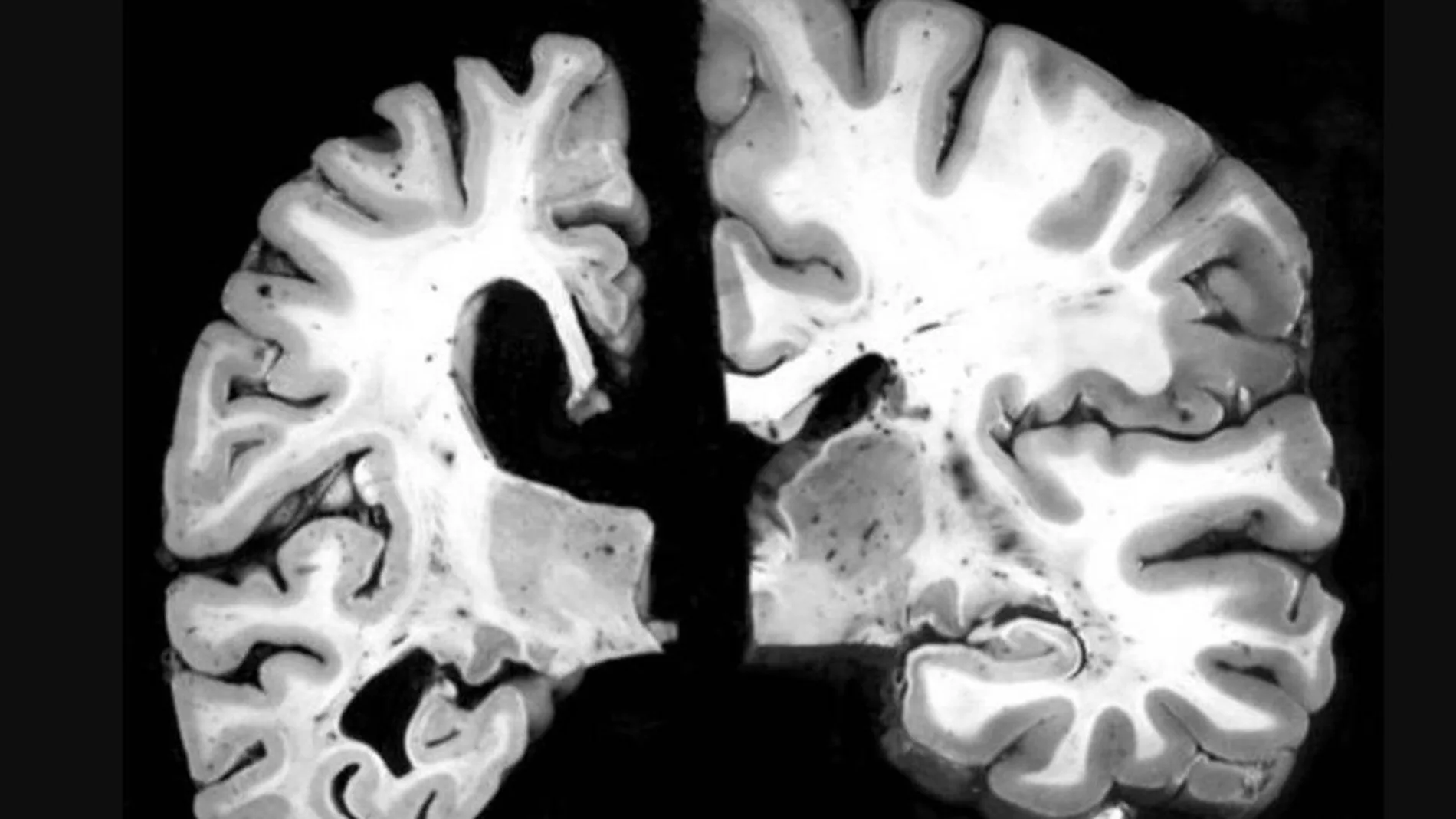 En la imagen de la izquierda, un cerebro con alzheimer. A la derecha,el cerebro sin la enfermedad