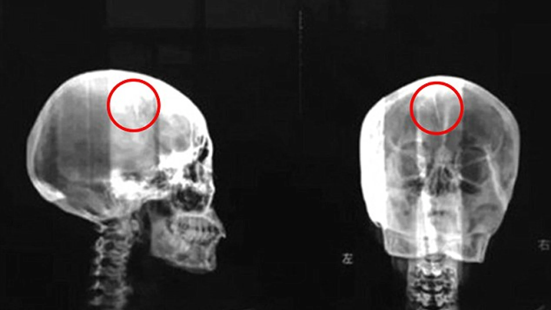Una mujer vive 48 años con una aguja en la cabeza