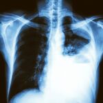 El estudio indica que el proceso de malignidad comienza cuando una pequeña porción de células en el tumor benigno se comportan como células madre