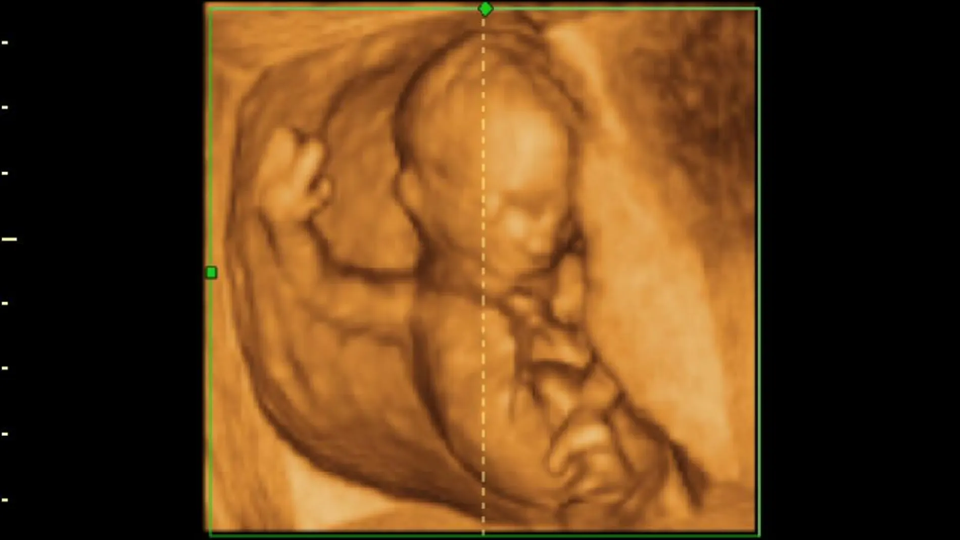 Un feto de 14 semanas en una ecografía en 3D